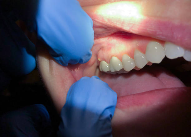 Best Chipped Tooth Repair Near Me  in Amelia, LA